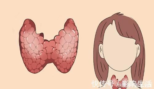 肿瘤医生|肿瘤医生:身体频繁有3个迹象,或是甲状腺癌“一级预警”