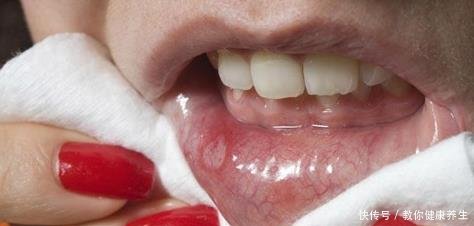 口腔溃疡怎么办不用急着吃药 教你一个 土办法 治疗 快资讯 口腔溃疡怎么办不用急着吃药 教你一个 土办法 治疗 快资讯