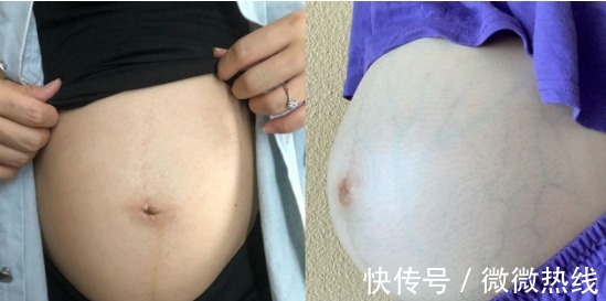 精华乳|怀孕后害怕身上长妊娠纹，注意这些要点，让妊娠纹离得远远的！