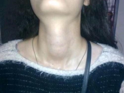 甲状腺|想要甲状腺结节松散，这4种东西建议要少碰，或许很多人都不清楚