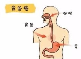 食管|咽炎和食道癌，到底如何区分？听专家讲解！