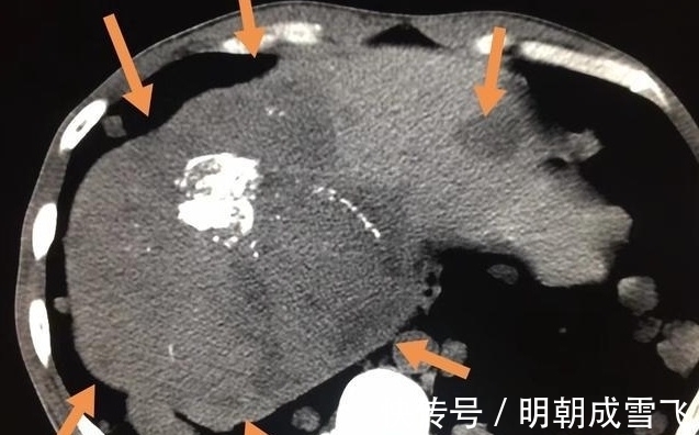 病人|癌症晚期病人差异这么大?有人可以5年以上,有人只有9天寿命?