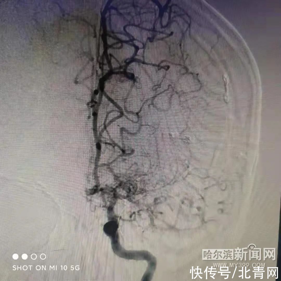 烟雾病|头晕反复犯，三两天就好？医生一查：脑袋里“少根儿筋”
