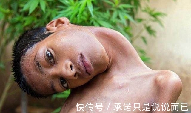 利瓦|男孩头部怪异,只能挂在胸前,手术7个月后的模样让人感动到哭!