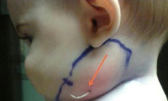 羽毛|宝宝脖子突然长羽毛,家人认为是天使,医生怒斥怎么当妈的!