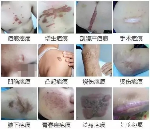 治疗 妩珩肤魅疤痕修复手术一般多少钱