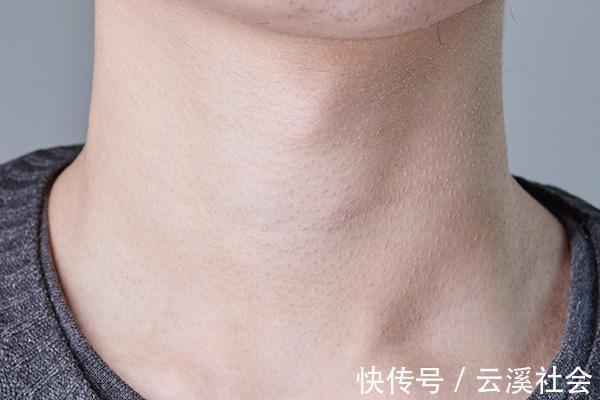 甲状腺激素|甲状腺出现结节,可能与三个原因相关,不想结节变大,要远离两物