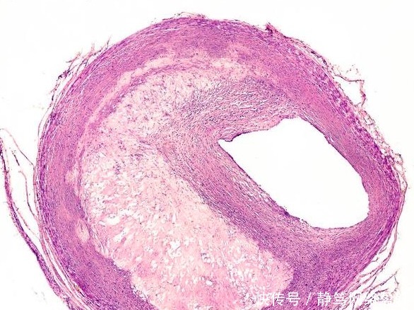 发生|脑供血不足真凶找到了!常吃3物,多做2动作,早坚持血管早安全