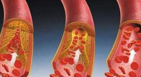 罗布麻茶|被称为“天然阿司匹林”，若能用叶子泡水喝，血栓被哗哗冲走
