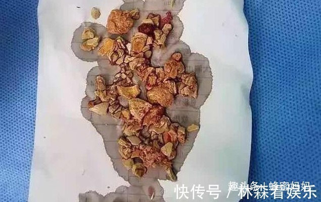 宝宝|5个月宝宝患“肾结石”,辅食成罪魁祸首,医生多数家庭还在喂