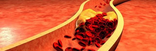洪水猛兽|高血脂是伤肾的“洪水猛兽”,这3大误区要改掉,有助于降血脂