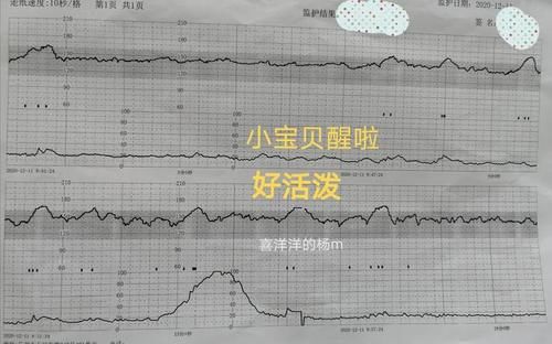 检查|孕38周+2天，做常规产检，胎心监测，羊水量检测，全过关