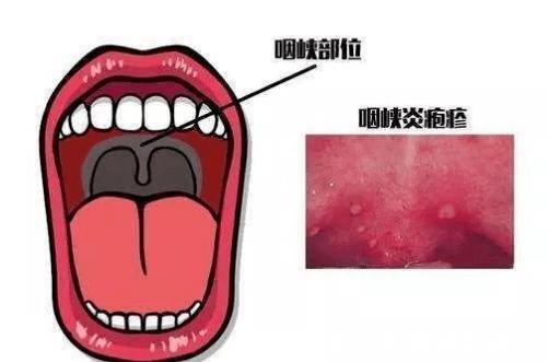 夏季|夏季:“疱疹性咽峡炎”进入高发期,一不小心宝宝就“中招”!