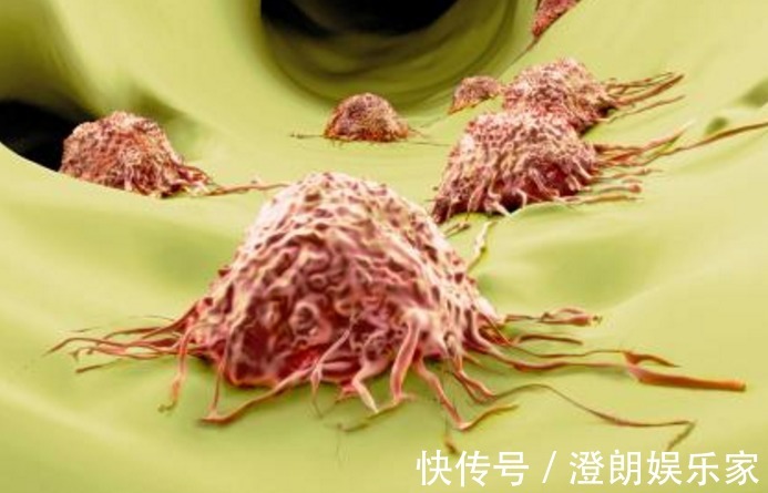 癌症|辟谣总听到“夫妻癌、兄弟癌”,癌症还会传染吗了解一下