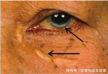 血脂高的人,通常会有3个特征,占1个,最好去检查一下