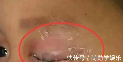 眼睛|孩子误拿502胶水滴眼睛,妈妈40秒内的处理方法,医生都夸奖