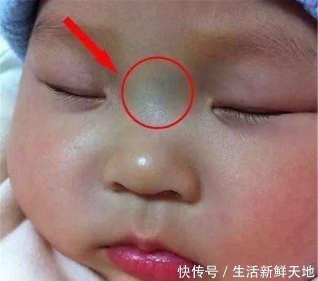 发育不良|宝宝鼻梁上有“青筋”,体质差脾气也大别因误会忽略真正的诱因!