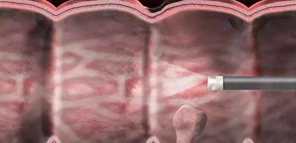 切除|以下两种息肉一定要及时切除,拖五年以上很可能变成恶性肿瘤