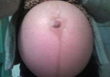 怀孕|女子怀孕肚子超大个个都以为双胞胎, 生的时候把接生的医生吓坏!