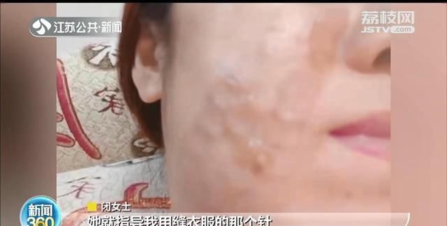 热玛吉|网红美容“热玛吉”频出事 皮肤抗衰老不成反被烫伤