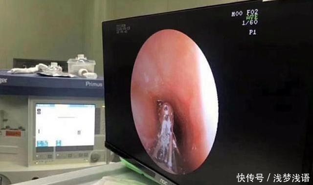 菲菲|男孩胃里发现一团“胶”,幕后真凶是这种“健康饮食”,脊背发凉!