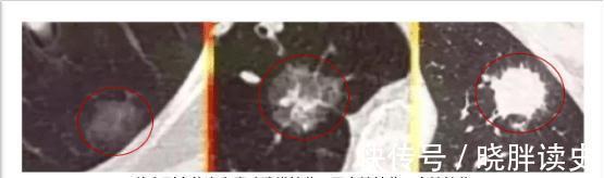 结节|肺上查出小结节,是“炸弹”还是虚惊一场?