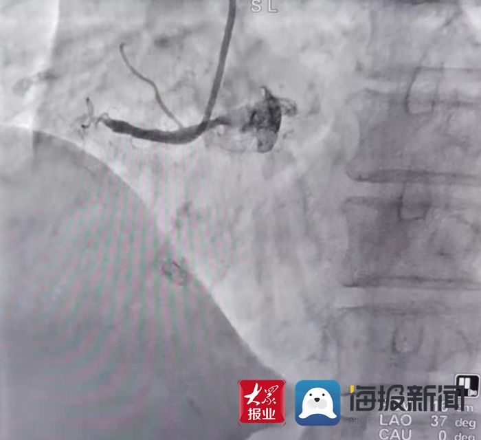 菏泽医专|菏泽医专附属医院成功救治94岁急性心肌梗死患者