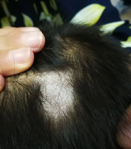 人家|7岁男孩头发一簇簇往下掉！罪魁祸首很多人家里都有！