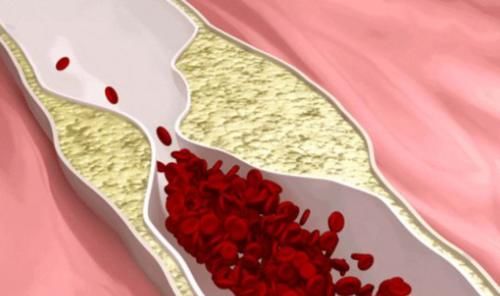 胆固醇|血脂高不可以吃蔬菜？提醒：3种食物或是“升脂大户”，别再贪吃