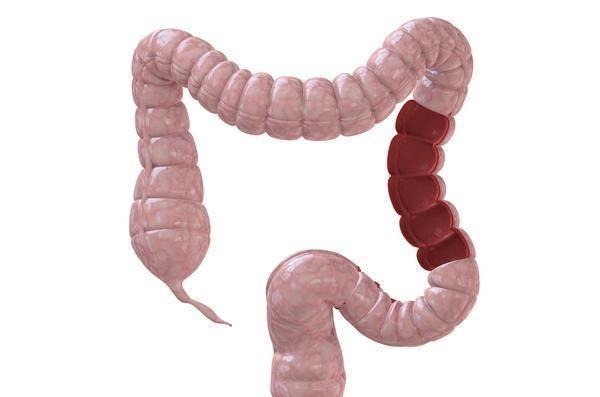 腫瘤|結腸癌查出多是晚期？醫生叮囑：這4種癥狀，別再視若無睹了！