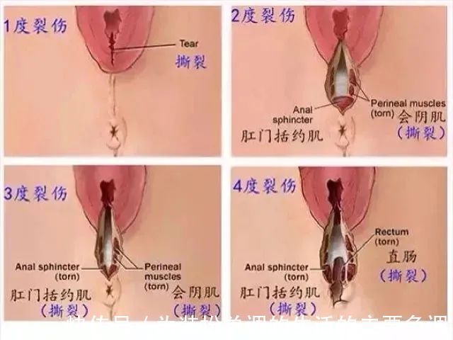 肛门|会阴侧切，并不是所有人都会挨这一刀！掌握这几招就可以避免！