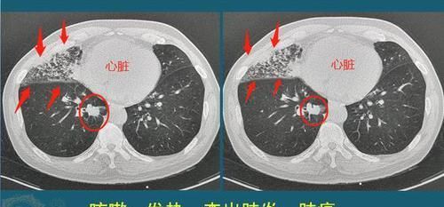 2个病例说明，好运气对癌症病人有多重要！