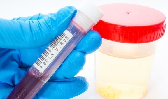 血糖|糖尿病患者的尿又黄又骚是什么原因？你真的知道吗？看专家的理解