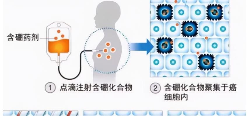 癌症|30分钟清零癌细胞！我国抗癌硼药完成中试，费用仅需10万元