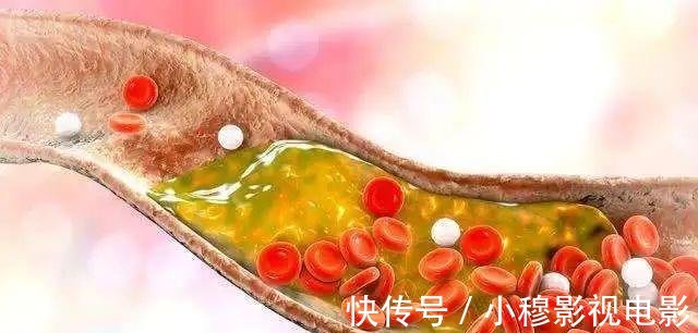 血液|当高血脂严重时,身体会出现这几种信号,或许已被“脑梗”盯上