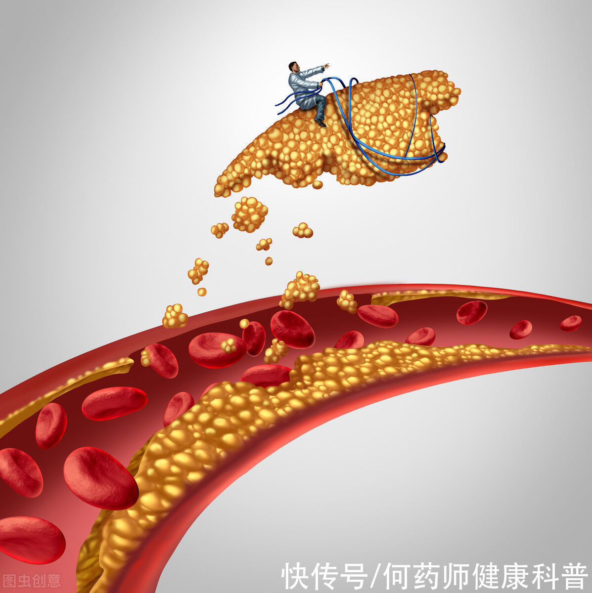 斑块|他汀类从源头上降血脂，缩小和稳定动脉粥样斑块，防止心血管事件