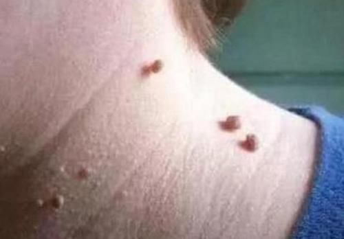 睡眠时间|脖子和腋下的“小肉粒”是什么?可以用手拉吗?