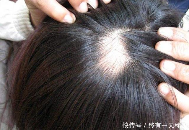 雄激素|李时珍每天泡“1物”，1周改善脱发，肾脏变强，头发乌黑亮丽