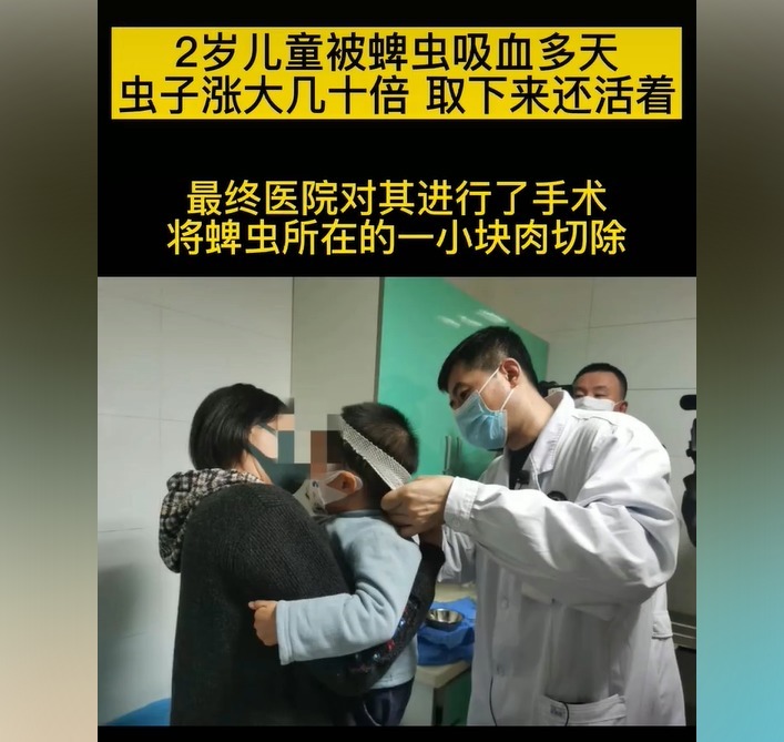 医生|3岁孩子被蜱虫咬,妈妈的“三个果断”救了娃,医生点赞有见识