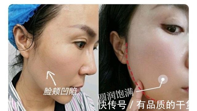 面部 玻尿酸填充的时候疼吗术后效果咋样!