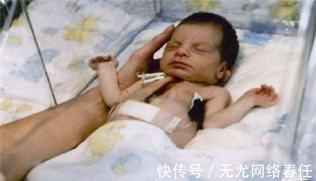 小菲伊|1984年美国女婴移植狒狒心脏,手术成功后,小女孩活了多久?