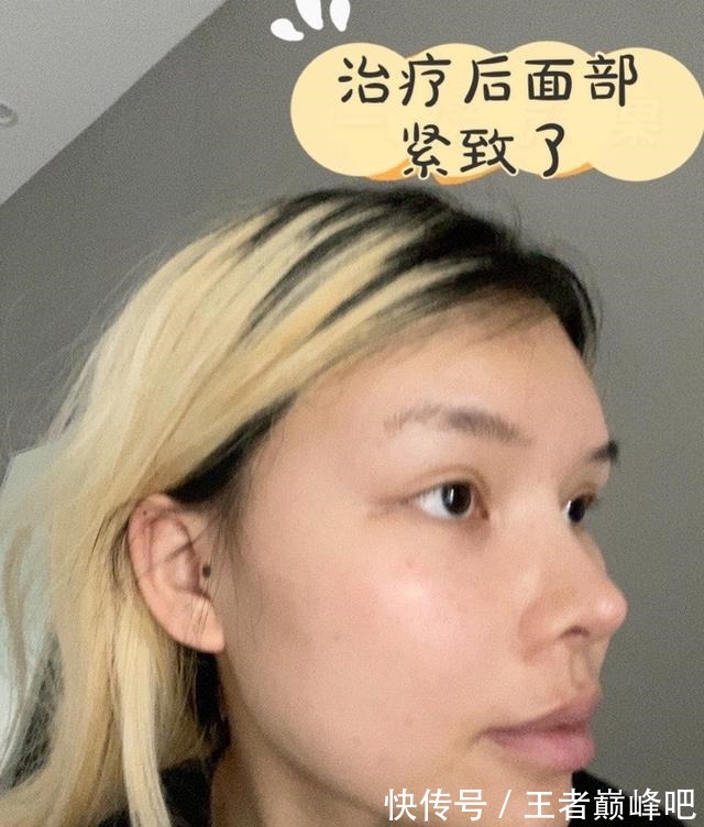 紧致 面部抗衰老,选热玛吉还是线雕提升!