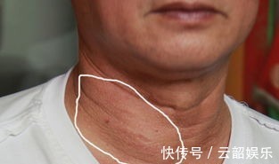 常吃|甲状腺有''结节''不用怕！常吃3种''消结王''，或许结节会慢慢变小