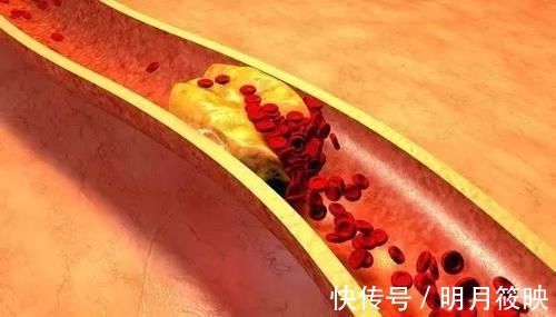 颈部|有颈动脉斑块的人还能跑步吗？斑块脱落会堵塞血管吗？