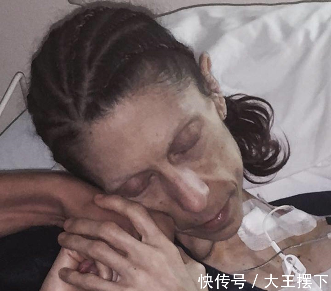 丈夫|妻子瘦到只有30斤,丈夫每天强迫她吃肉,如今发生翻天覆地的变化