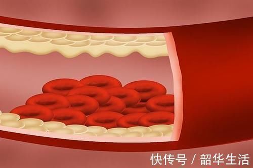 血小板|经常吃洋葱的人,体内不易出现血栓?是真的吗?专家说得很有道理