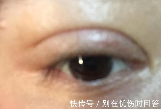 瘢痕 双眼皮术后出现肉条的不同原因和修复方法