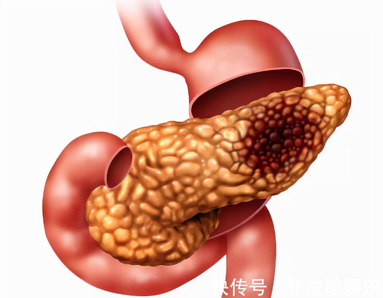 胃溃疡|我国癌症误诊率约在30%左右,提醒:3种癌症易被误诊,要重视