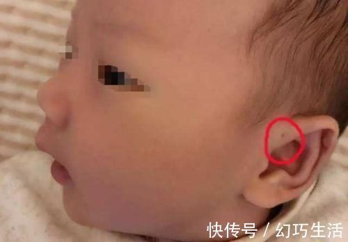 宝妈|为啥有些新生儿耳朵有小孔?医生一般不会主动讲,家长心里要有数