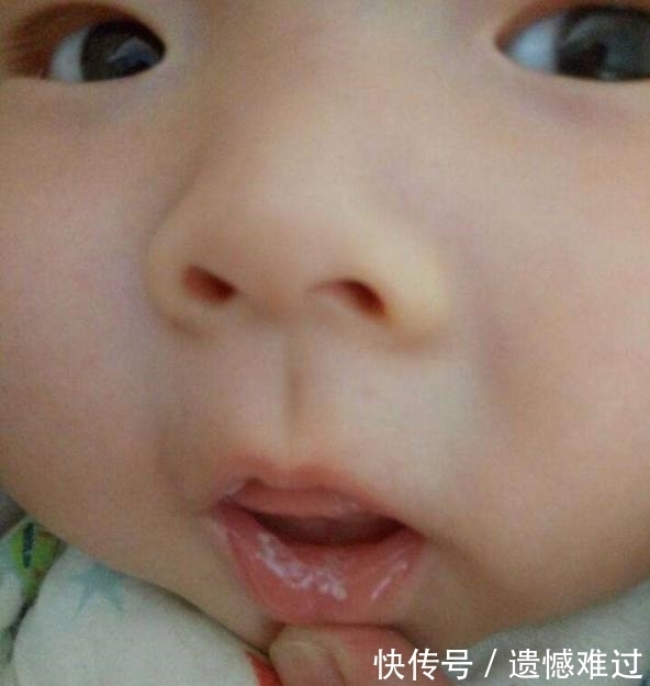 嘴角|宝宝的嘴角烂了是什么原因?又该怎么办?